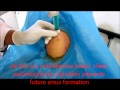 Large Abscess Cavity Pus Aspiration With Anti Gravity Technique