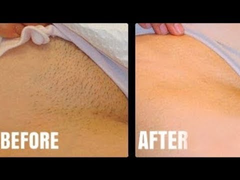 Prevent razor bumps bikini line