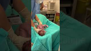 Epidural sezaryen ile annesi ve babasının süper bebeği dünyaya geliyor (kombine epidural anestezi).