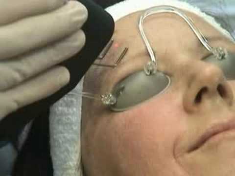 laser dermatologie dermatologie -aplicatii laser in dermatologie