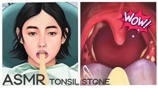 Asmr Tonsil Stone Satisfying White Tongue & Tonsil Stones Removal Mengs Stop Motion