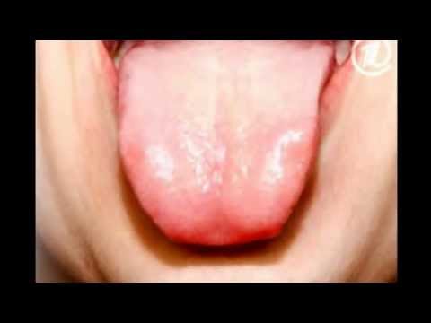 0 - Пухирі на корені язика: причини появи шишок, можливі захворювання