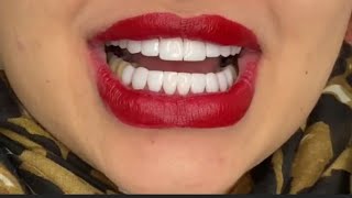 Females Teeth Veneers Teeth Review