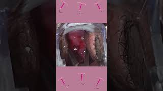Parte 1 Colocación De Mira Como Se Lo Coloco A Mi