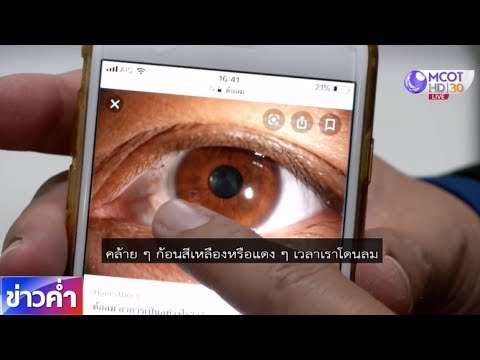 ชัวร์ก่อนแชร์ : ต้อลมต้อเนื้อ รักษาไม่หาย ต้องไม่ให้ลุกลาม?