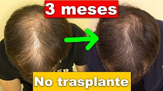Recuperación pelo 3 meses sin trasplante