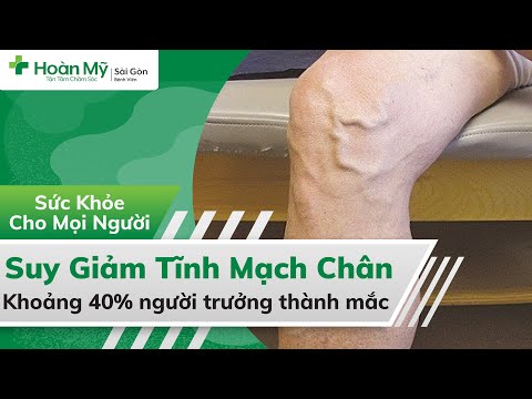 Suy giãn tĩnh mạch chân | Biết rõ Nguyên nhân, Biến chứng và Điều trị (chữa)