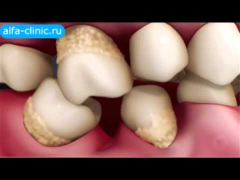 Потеря зубов к чему приводит Потеря зубов к чему приводит