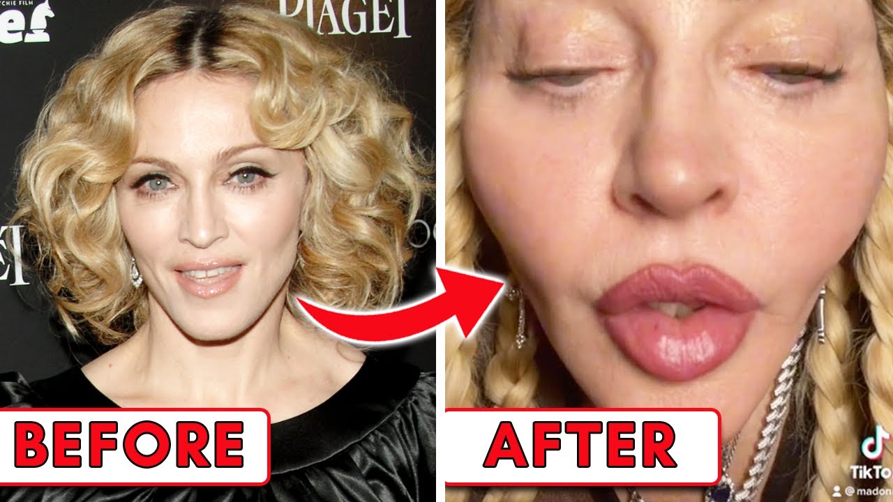 Madonna Plastic Surgery