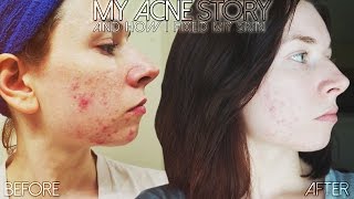 to treat acne irishhealth my son now 19 had very bad acne to treat acne irishhealth my son now 19 had very bad acne