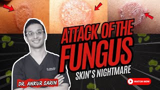 How To Treat Fungal Infection Of Skin Ringworm Dr. Sarin