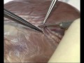 Anastomosis