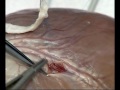Anastomosis