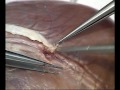 Anastomosis