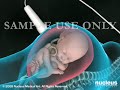 3D Medical Animation Cesarean Birth (C-section)