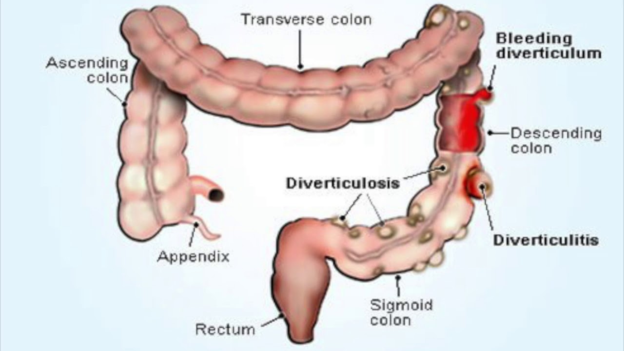 Дивертикулит Сигмовидной Кишки Симптомы И Лечение Диета