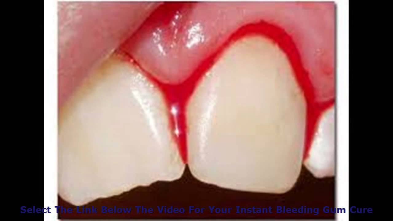 Как вылечит десны которые кровоточат Как вылечит десны которые кровоточат