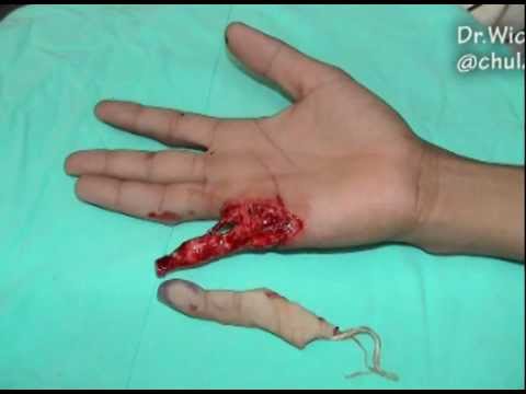 finger replantation