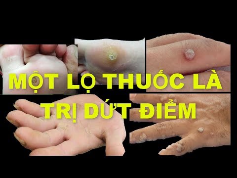 THUỐC BẢO ĐẢM TRỊ DỨT ĐIỂM MỤN CÓC - MỤN CƠM - VẾT CHAI SẦN - MẮT CÁ CHÂN