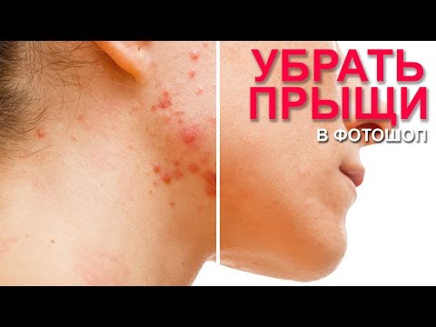 Как за месяц избавиться от прыщей в домашних условиях Как за месяц избавиться от прыщей в домашних условиях