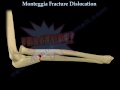 Monteggia Fracture Dislocation  - Everything You Need To Know - Dr. Nabil Ebraheim