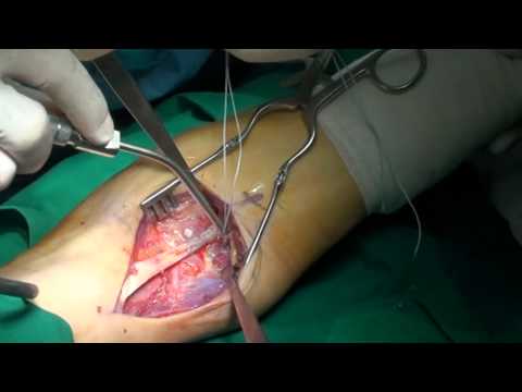 DISTAL BICEPS TENDON RUPTURE, Dr. George GOUDELIS, Video 2 - YouTube
