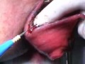 PERIANAL ABSCESS