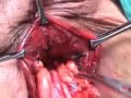 PERIANAL ABSCESS