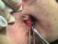 PERIANAL ABSCESS