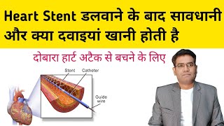 Heart Stent डलवन क बद सवधन दवईय और खनपन कस रख Medicines After Stent Placement