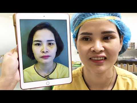 Chỉnh Sửa Mắt 2 Mí Đều 10/10 Chỉ Có Tại Dr.Hải Lê.