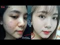 Bí quyết TRỊ SẠCH MỤN đầy mặt sau 14 ngày của cô nhân viên văn phòng 23 tuổi