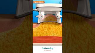 Cryolipolysis For Fat Reduction 3D Medical Animation       