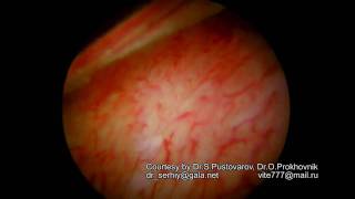 Submucous Myoma Fibroid Iii Hd
