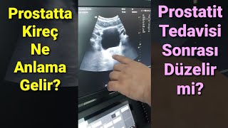 Prostat Kireçlenmesi Ne Anlama Gelir? Prostat İltihabı Tedavisi Sonrası Ortadan Kalkar Mı?