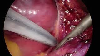 Left Thoracoscopic Approach for Convergent AF Ablation: How to do Everything From the Same Side