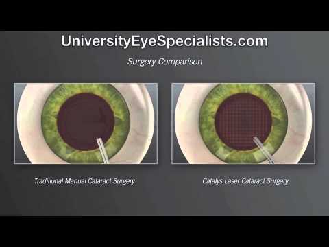 University Eye Specialists: Laser Cataract Surgery'][0].replace('