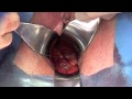 sacrospinous ligament fixation (sacrospinous hysteropexy)