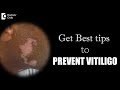 How can one prevent spreading of vitiligo? - Dr. Nischal K