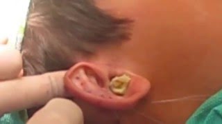 Otoplasty Performed By David L. Cangello, Md, Facs