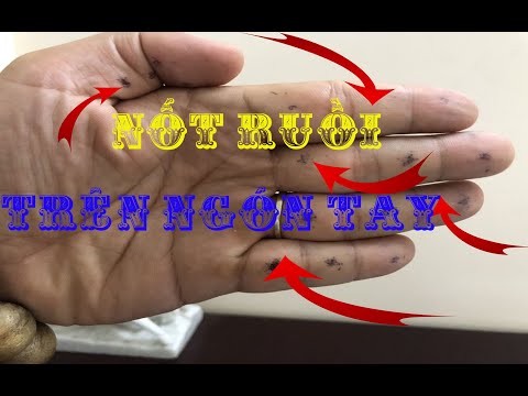 Nốt ruồi trên ngón tay | xem chỉ tay 0899853777 Zalo