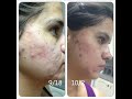 my PMD (personal microderm) experience part #1