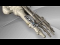 First Metatarsophalangeal Joint Fusion with Arthrex® MTP Fusion Plate