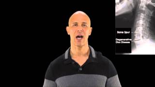 Bone Spurs, Osteophytes, Arthritis In Neck Dr Mandell