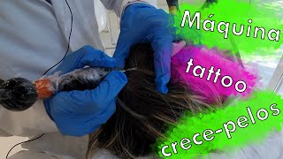 ¿Usar MÁQUINA de TATUAR para MEJORAR la ALOPECIA?