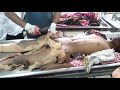 Postmortem video||Dissection human body ||Alcohol patient Postmortem video||Dissection human body ||Alcohol patient