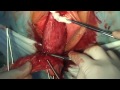 Utero vaginal prolapse vaginal hysterectomy