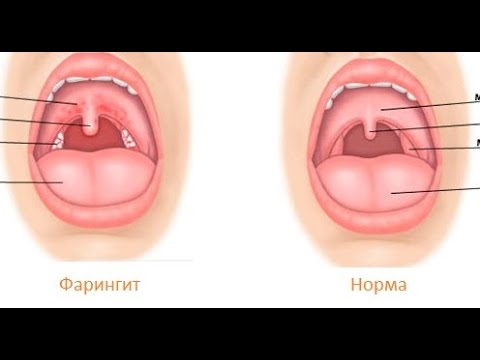 Фарингит симптомы и лечение у взрослых в домашних условиях пошагово в Фарингит симптомы и лечение у взрослых в домашних условиях пошагово в