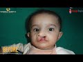 Free Cleft Lip and Palate Surgery Treatment at Saraswat Hospital under Smile Train.