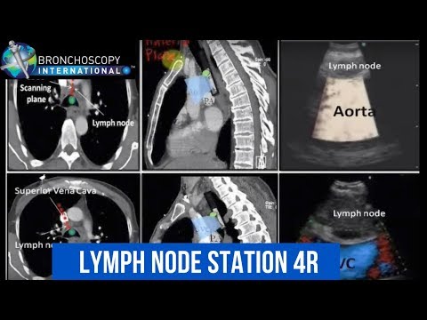 BronchAtlas EBUS Identification lymph node station 4R - YouTube